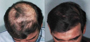 Advanced Hair Restoration before and after photo, actual patient.